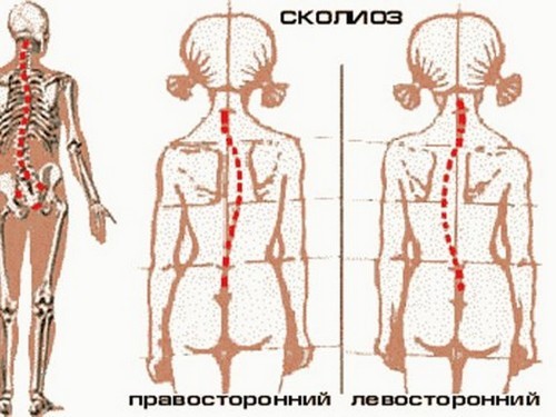 Вправи для виправлення сколіозу в домашніх умовах