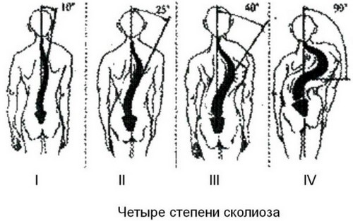 Вправи для виправлення сколіозу в домашніх умовах